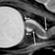 Too much pressure: A build-up of cerebrospinal fluid is cited as the cause of nearsightedness in long-duration astronauts. (Image: Alperin et al.)